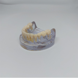 Implantat/Bro Studiemodel 